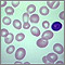 Megaloblastic anemia - view of red blood cells