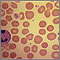 Red blood cells, spherocytosis