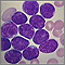 Acute lymphocytic leukemia - photomicrograph