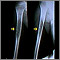 Ewings sarcoma - X-ray