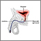 Inflatable artificial sphincter - series