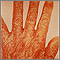 Scabies rash and excoriation on the hand