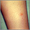 Chickenpox - lesion on the leg