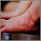 Erythema toxicum on the foot