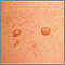 Molluscum contagiosum - close-up