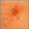 Molluscum contagiosum - close-up of the chest