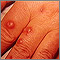 Cryptococcus, cutaneous on the hand