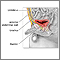 Patent urachus repair - series