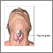 Thyroidectomy - series