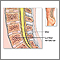 Bone graft - series