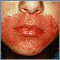 Candidiasis, cutaneous - around the mouth