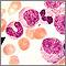 Chronic myelocytic leukemia - microscopic view