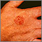 Bowen's disease on the hand