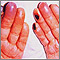 Cryoglobulinemia - of the fingers