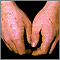 Erythema multiforme on the hands