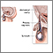 Hydrocele repair - series