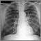 Adenocarcinoma - chest X-ray