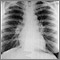 Sarcoid, stage I - chest X-ray