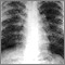 Sarcoidosis, estado II - radiografía de tórax