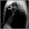 Pulmonary mass - side view chest X-ray