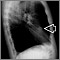 Lung nodule, right middle lobe - chest X-ray