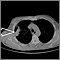 Lung mass, right lung - CT scan