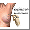 Open biopsy of the breast