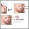 Lumpectomy