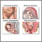 Cesarean section