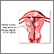 Fibroid tumors