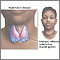 Hashimoto's disease (chronic thyroiditis)