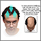 Male pattern baldness