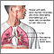 CMV pneumonia