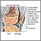 Rheumatoid arthritis