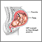 Congenital cytomagalovirus