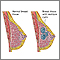 Fibrocystic breast disease