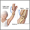 Radial head injury