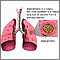 Aspergilloma