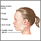 Infectious mononucleosis