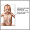 Neonatal adrenoleukodystrophy