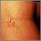 Striae in the popliteal fossa