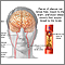 Atherosclerosis of internal carotid artery