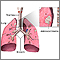 Adenocarcinoma