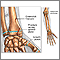 Fractures across a growth plate