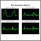 Post myocardial infarction ECG wave tracings