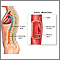 Aortic dissection