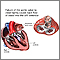 Aortic insufficiency