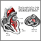 Aortic stenosis