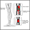 Arterial embolism