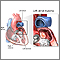 Left atrial myxoma